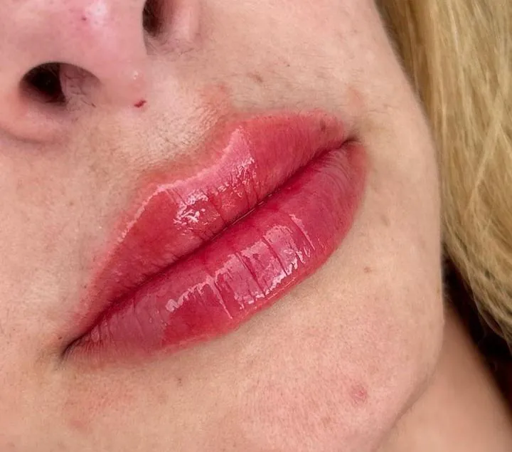 Resultado do preenchimento labial na JB Estética