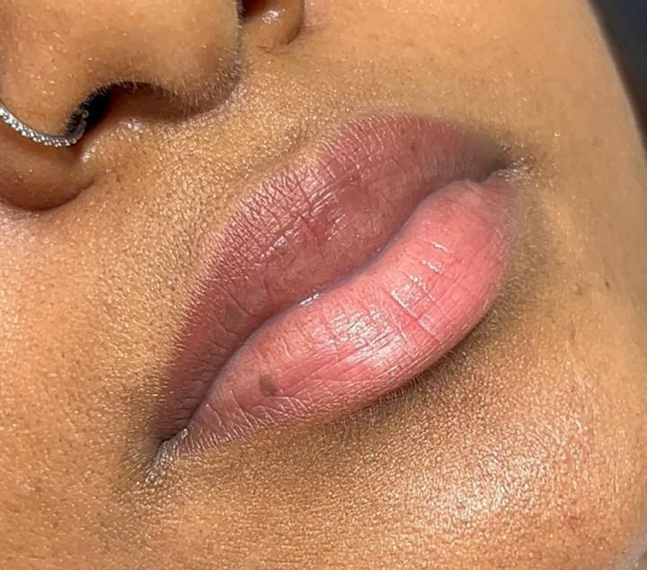 Antes do preenchimento labial