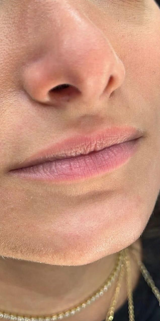 Antes do preenchimento labial