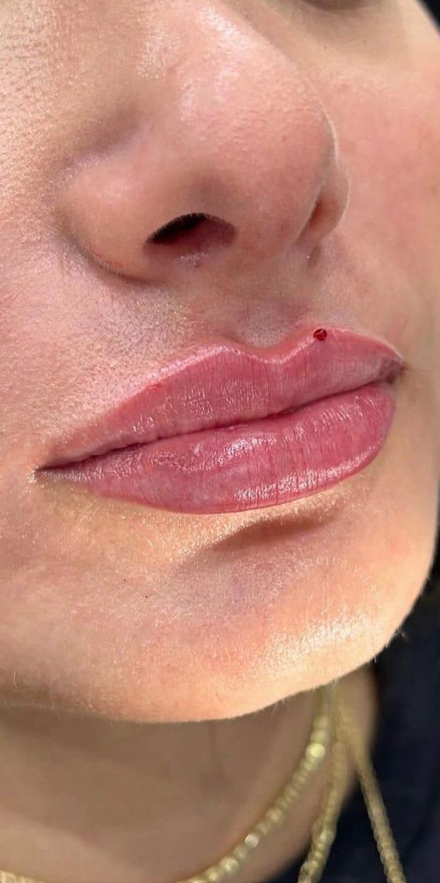 Resultado do preenchimento labial na JB Estética